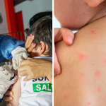 Confirman brote de sarampión en Loreto: Defensoría del Pueblo pide acciones urgentes para frenar transmisión